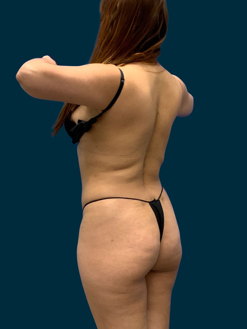 Fat Transfer Before & After Gallery - Patient 171522 - Image 7