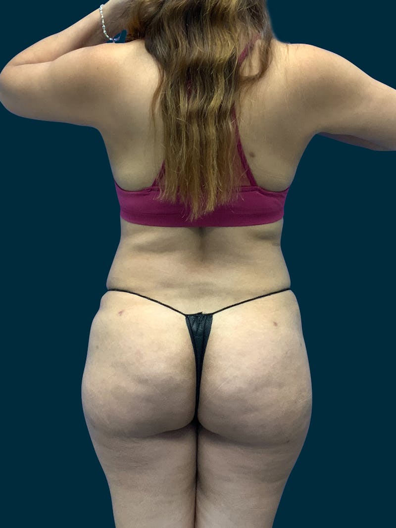 Fat Transfer Before & After Gallery - Patient 171522 - Image 2