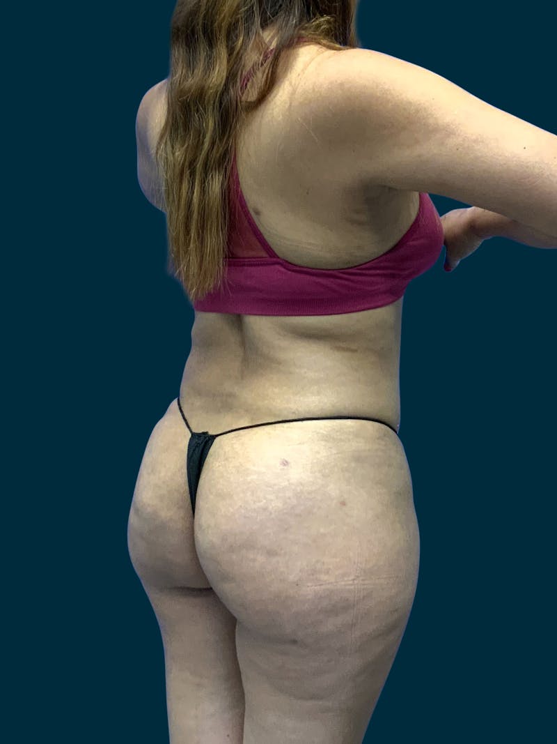 Fat Transfer Before & After Gallery - Patient 171522 - Image 4