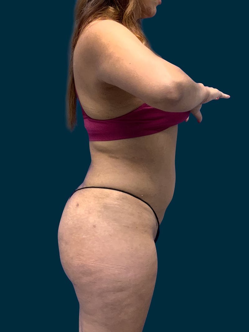 Liposuction Before & After Gallery - Patient 308406 - Image 6