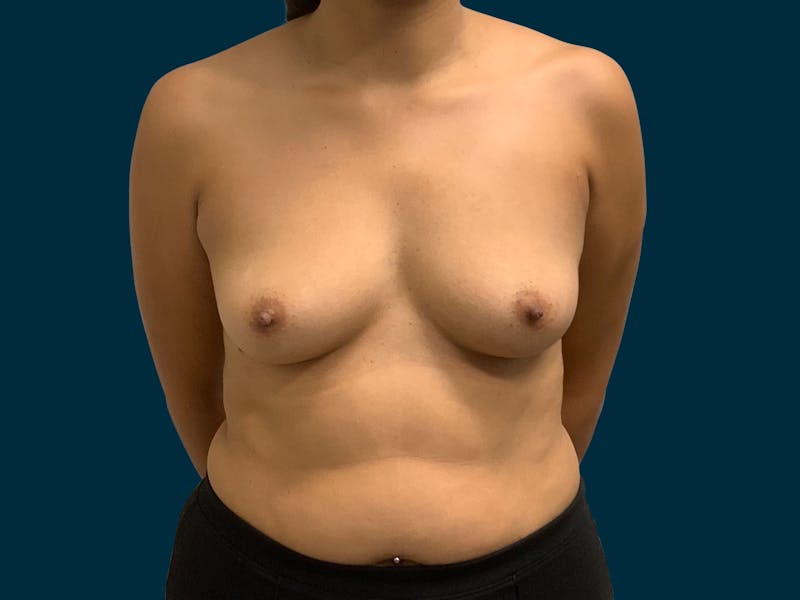 Breast Augmentation Before & After Gallery - Patient 429220 - Image 1