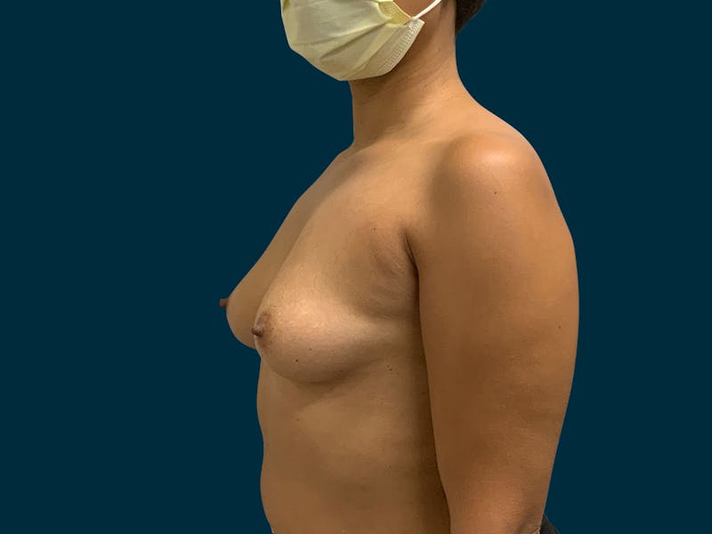 Breast Augmentation Before & After Gallery - Patient 429220 - Image 3