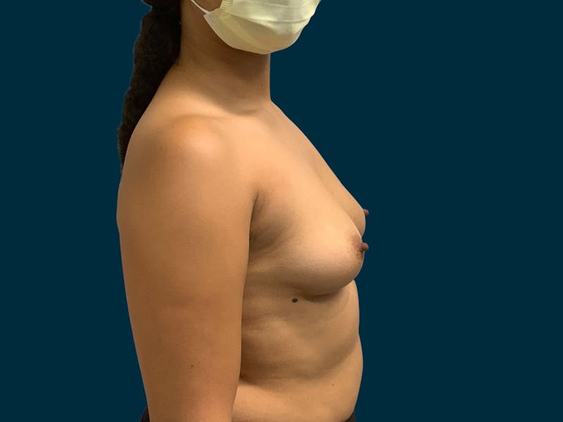 Breast Augmentation Before & After Gallery - Patient 429220 - Image 5