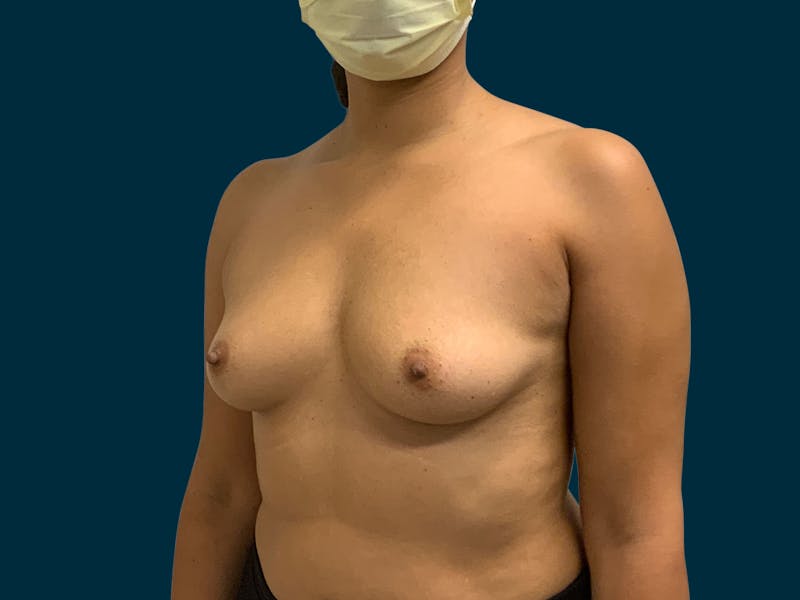 Breast Augmentation Before & After Gallery - Patient 429220 - Image 7