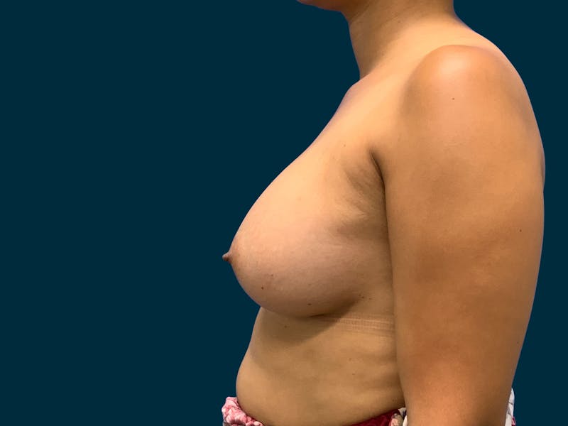 Breast Augmentation Before & After Gallery - Patient 429220 - Image 4