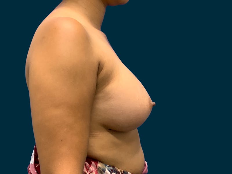 Breast Augmentation Before & After Gallery - Patient 429220 - Image 6
