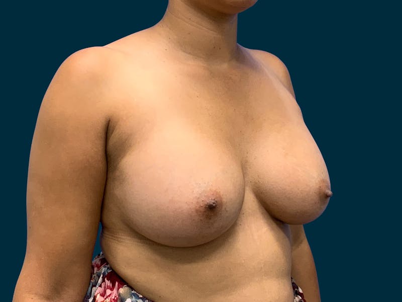 Breast Augmentation Before & After Gallery - Patient 429220 - Image 10