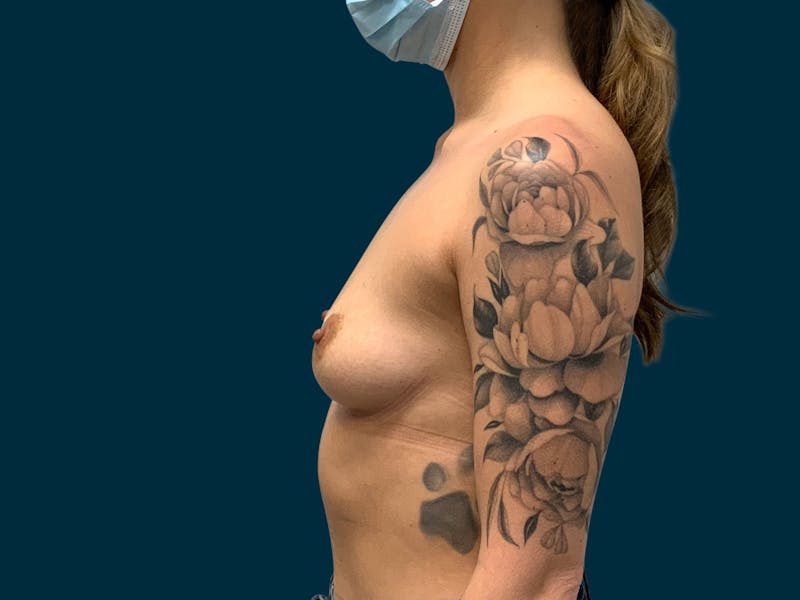 Breast Augmentation Before & After Gallery - Patient 931099 - Image 3