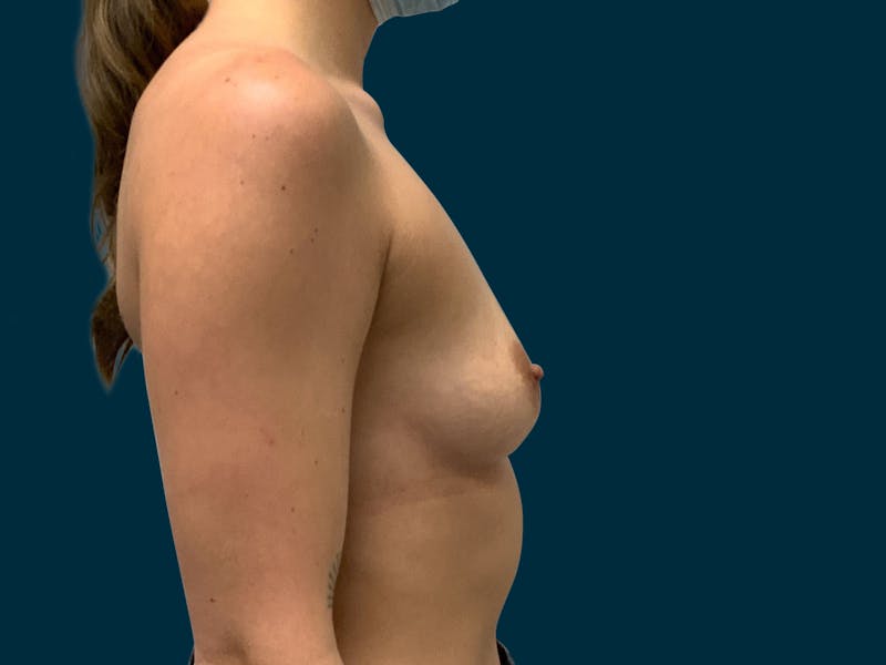 Breast Augmentation Before & After Gallery - Patient 931099 - Image 9