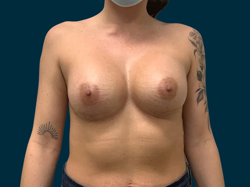 Breast Augmentation Before & After Gallery - Patient 931099 - Image 2