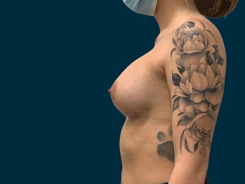 Breast Augmentation Before & After Gallery - Patient 931099 - Image 4