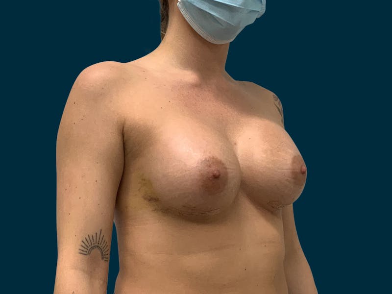 Breast Augmentation Before & After Gallery - Patient 931099 - Image 8