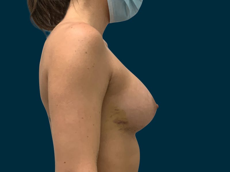 Breast Augmentation Before & After Gallery - Patient 931099 - Image 10