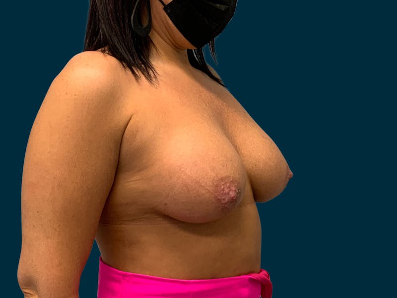 Breast Augmentation Before & After Gallery - Patient 192049 - Image 4