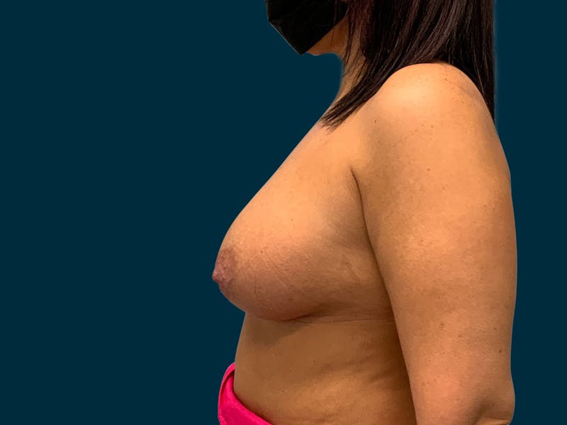 Breast Augmentation Before & After Gallery - Patient 192049 - Image 6
