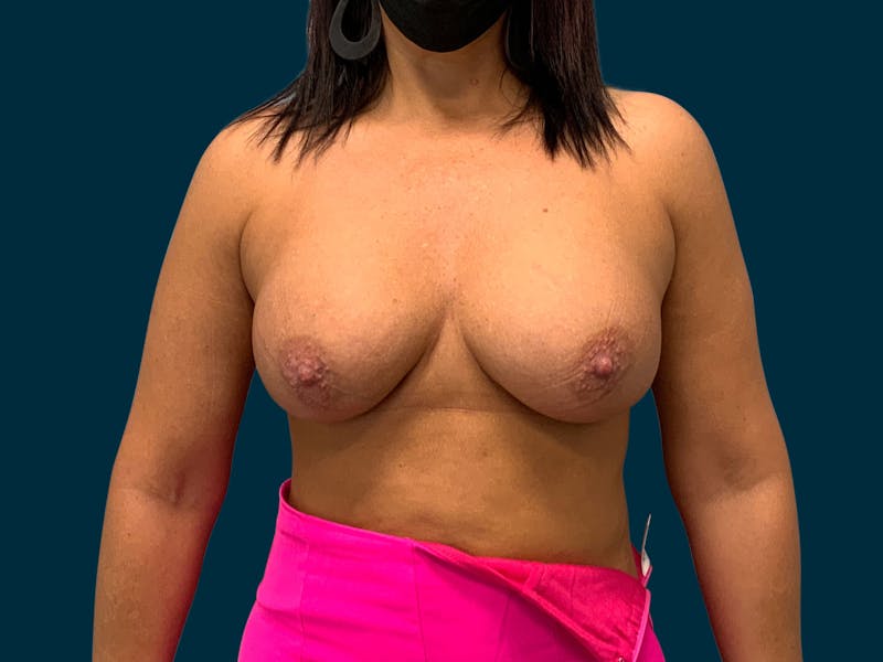 Breast Augmentation Before & After Gallery - Patient 192049 - Image 2