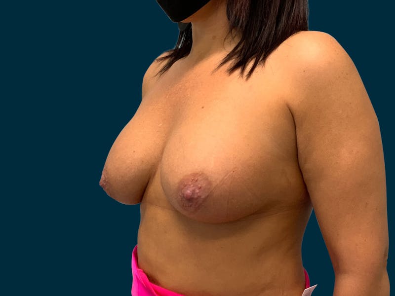 Breast Augmentation Before & After Gallery - Patient 192049 - Image 10