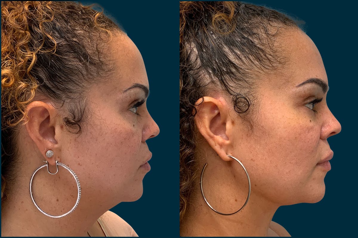 Chin & Neck Liposuction Before & After Gallery - Patient 410870 - Image 2