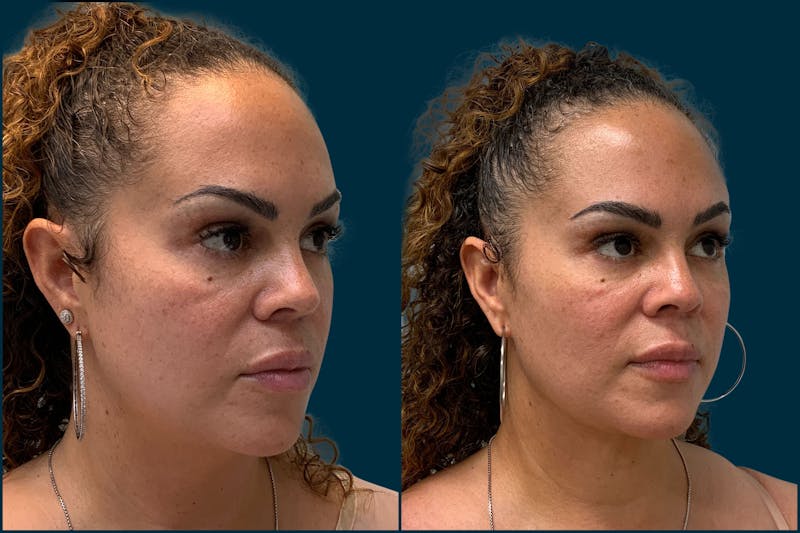 Chin & Neck Liposuction Before & After Gallery - Patient 410870 - Image 1
