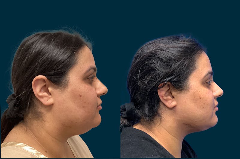 Patient jIIQgNfJTOeir-X5GFIeqQ - Buccal Fat Removal Before & After Photos
