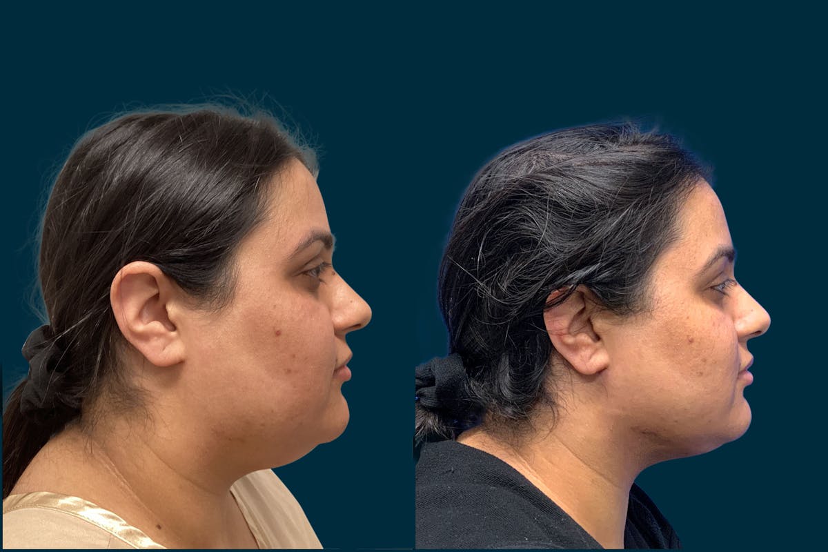Buccal Fat Removal Before & After Gallery - Patient 795070 - Image 1