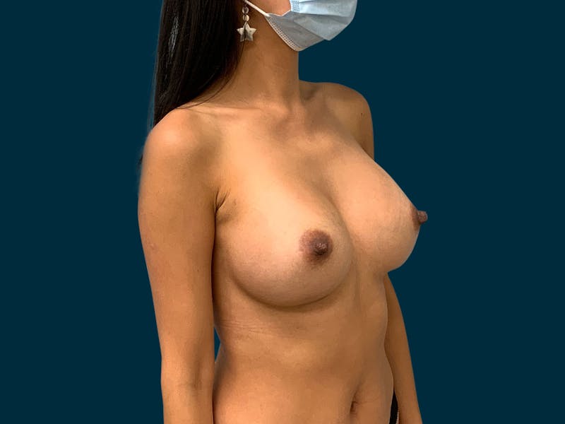 Breast Revision Before & After Gallery - Patient 327210 - Image 6