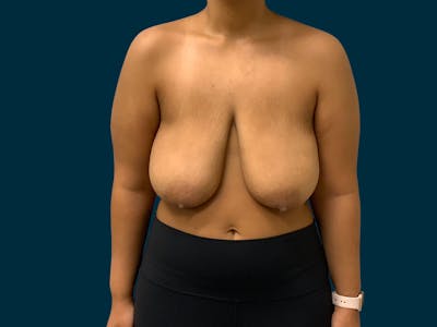 Breast Lift Before & After Gallery - Patient 817350 - Image 1