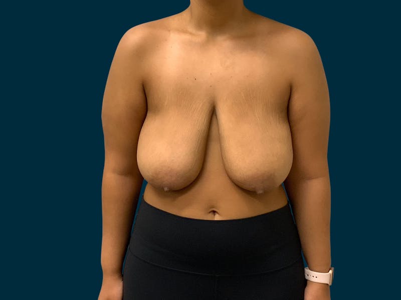Breast Lift Before & After Gallery - Patient 817350 - Image 1