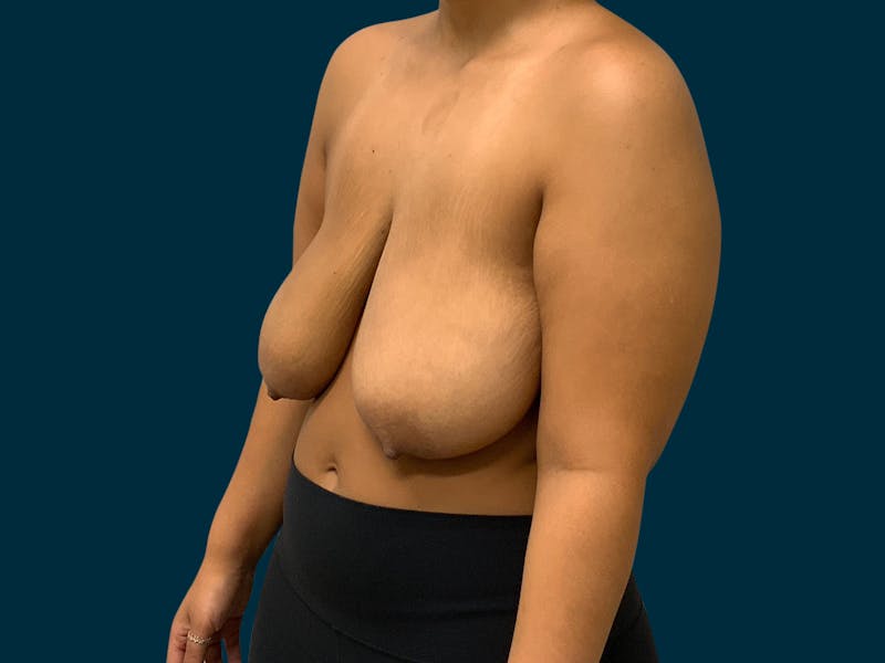 Breast Lift Before & After Gallery - Patient 817350 - Image 3