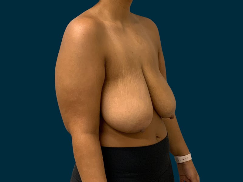 Breast Lift Before & After Gallery - Patient 817350 - Image 5