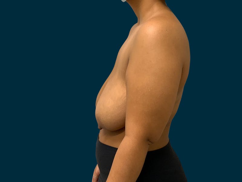 Breast Lift Before & After Gallery - Patient 817350 - Image 7
