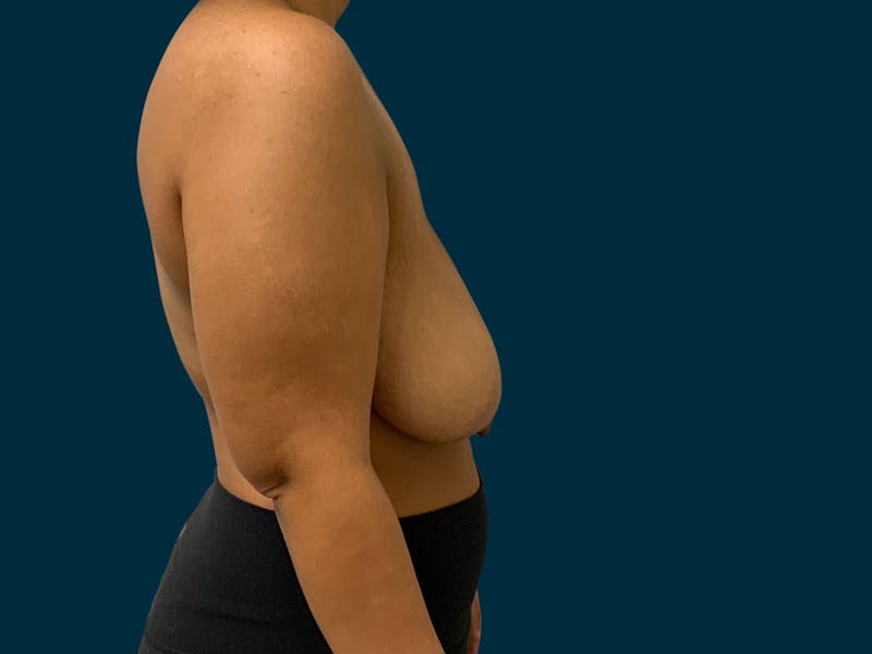 Breast Lift Before & After Gallery - Patient 817350 - Image 9