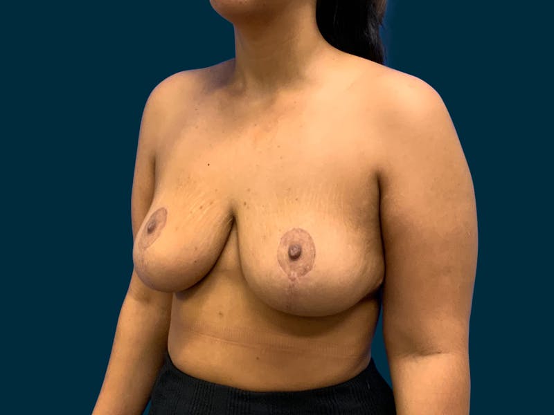Breast Lift Before & After Gallery - Patient 817350 - Image 4