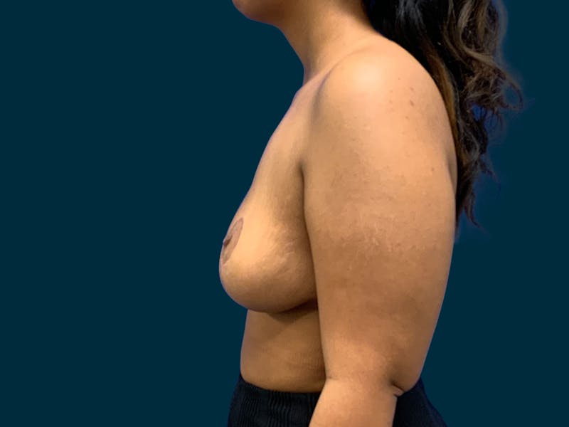 Breast Lift Before & After Gallery - Patient 817350 - Image 8