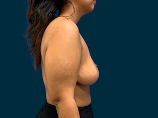 Breast Lift Before & After Gallery - Patient 817350 - Image 10