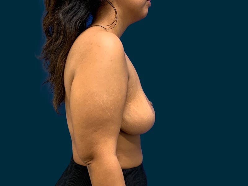 Breast Lift Before & After Gallery - Patient 817350 - Image 10