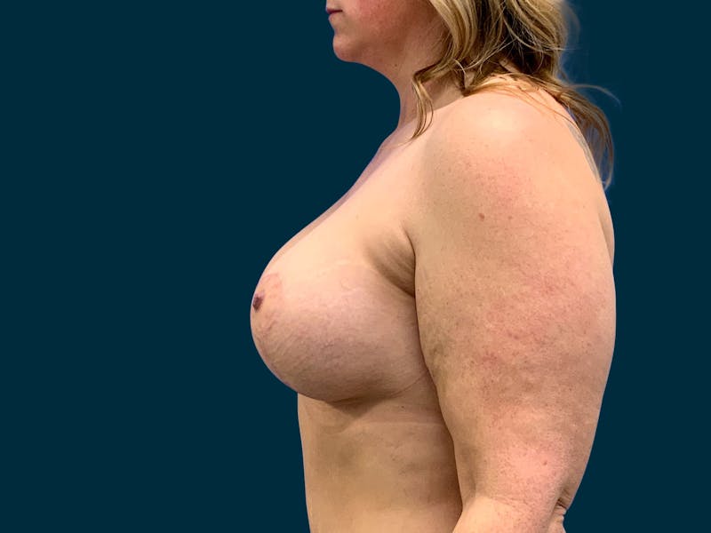 Breast Lift Before & After Gallery - Patient 415705 - Image 6