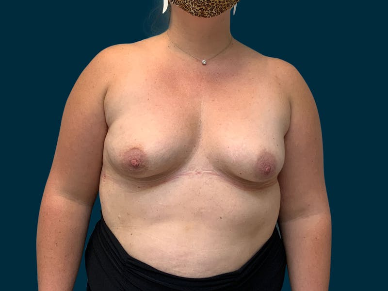 Breast Augmentation Before & After Gallery - Patient 835749 - Image 1