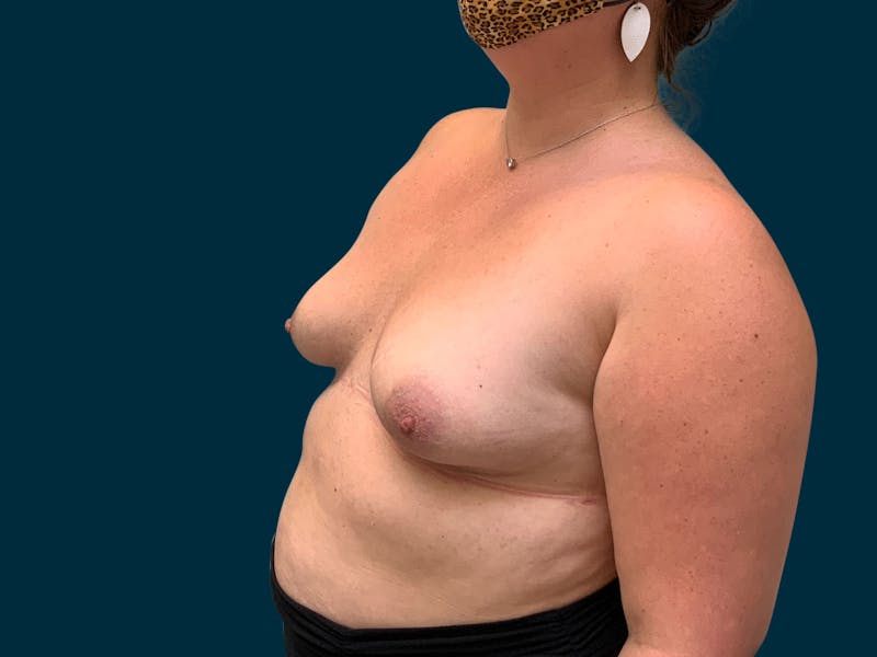 Breast Augmentation Before & After Gallery - Patient 835749 - Image 3