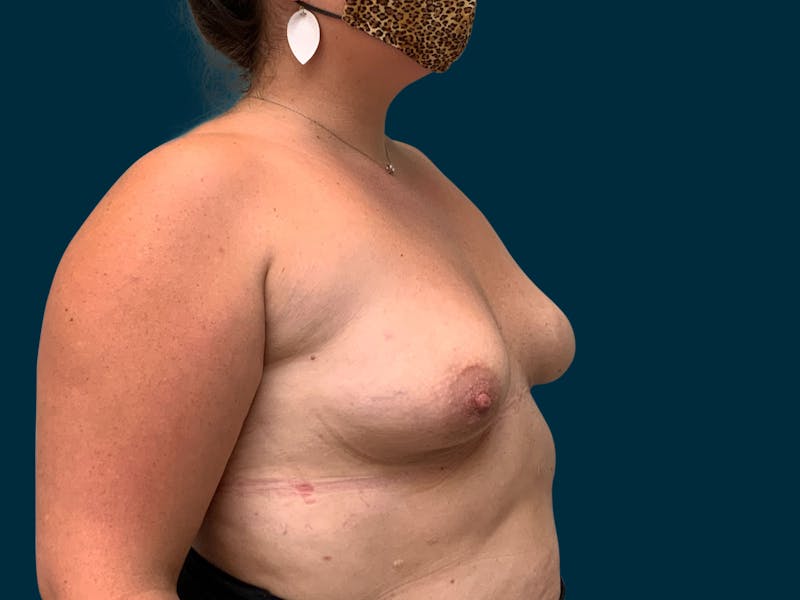 Breast Augmentation Before & After Gallery - Patient 835749 - Image 5