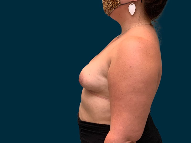 Breast Augmentation Before & After Gallery - Patient 835749 - Image 7