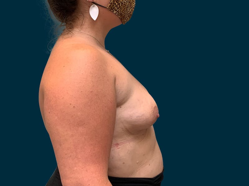 Breast Augmentation Before & After Gallery - Patient 835749 - Image 9