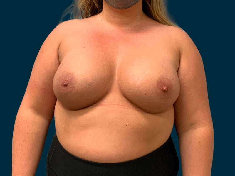 Breast Augmentation Before & After Gallery - Patient 835749 - Image 2
