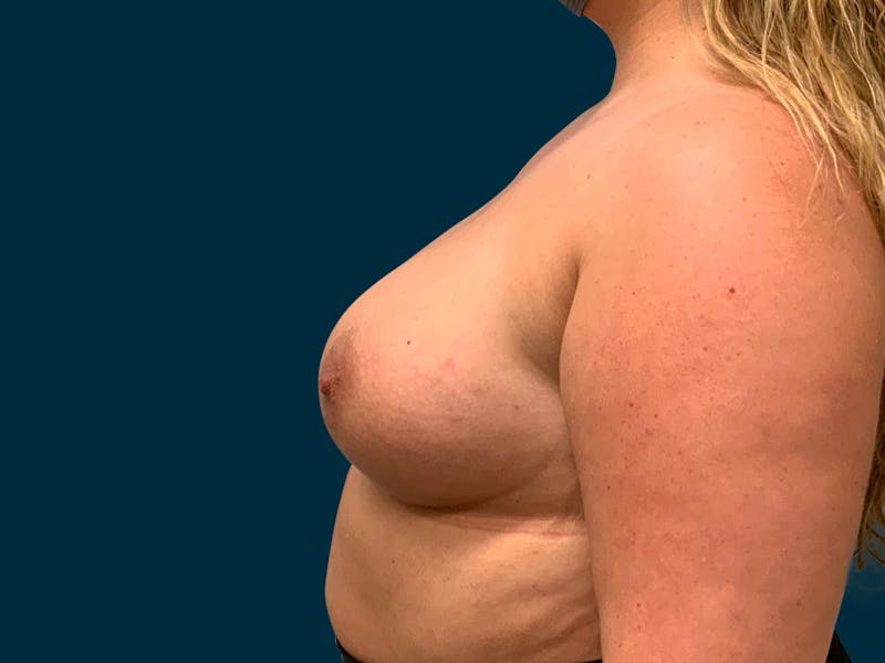 Breast Augmentation Before & After Gallery - Patient 835749 - Image 8
