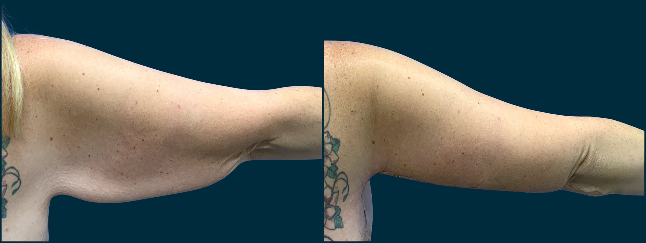 Brachioplasty Before & After Gallery - Patient 692157 - Image 1