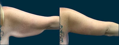 Brachioplasty Before & After Gallery - Patient 692157 - Image 1