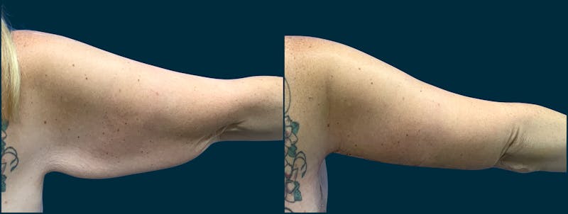 Patient TxJbDtakS12TsYKjWgUHIg - Arm Lift Before & After Photos