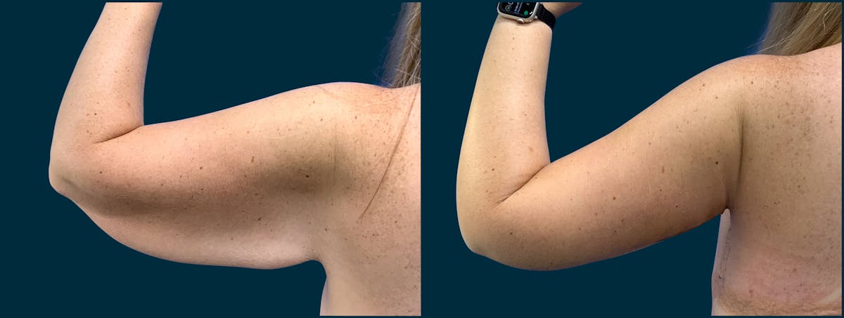 Brachioplasty Before & After Gallery - Patient 692157 - Image 2