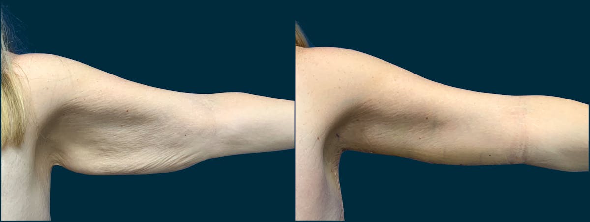 Brachioplasty Before & After Gallery - Patient 692157 - Image 3