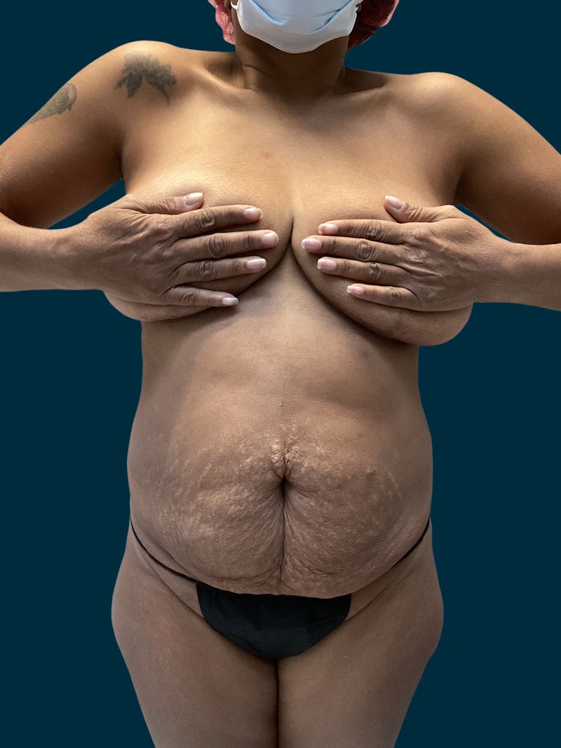 Abdominoplasty Before & After Gallery - Patient 242083 - Image 1
